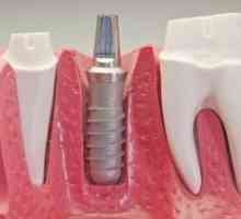 Ce sunt implanturile dentare: tipuri și descriere
