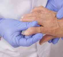 Ce arthritis boală și cum să o tratezi