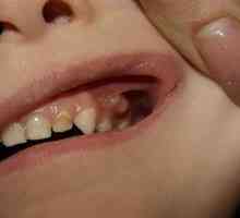 Gum pe gingiile unui copil: simptome și tratament