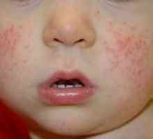 Dermatita la un copil: principalele cauze, metode de tratament și fotografii
