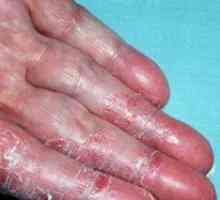 Dermatita pe mâini: tratament și fotografii