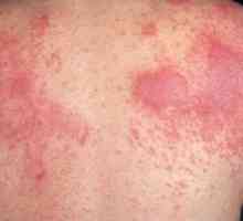 Dermatita: tipuri, fotografii ale simptomelor și tratamentului