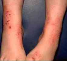Dermatita la copii pe picioare: fotografii, tipuri și moduri de tratament