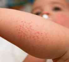 Dieta la copiii cu dermatită atopică