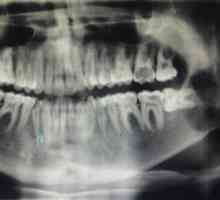 Ce este radiografia dintelui în stomatologie?