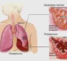 Pneumonie pe două fețe: cum să vindeciți pneumonia?