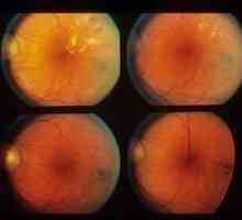 Retinopatia de fond și modificările vasculare ale retinei