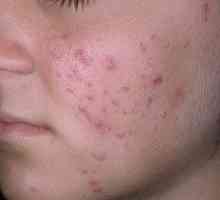 Fotografie de acnee pe fata si tratament