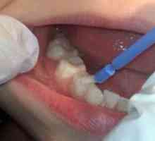 Fluoridarea dinților la copii - o garanție a mușcăturii sănătoase