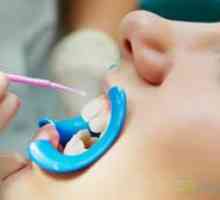 Fluorizarea dinților la copii: beneficiu, preț