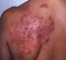 Herpesul pe corp: descriere și fotografie