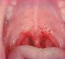 Stomatita herpesului la copii: simptome și tratament