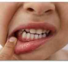 Gingivita la copii: forme de boală a gingiilor