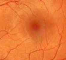 Angioscleroza hipertensivă a retinei - nu întârziați tratamentul!