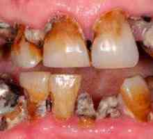 Dentiții înțepați la un copil și la un adult: de ce dinții încep să putrezească