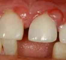Granulomul dentar: Simptomele și tratamentul bolilor