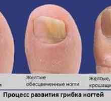 Ciuperca pe unghiile picioarelor: cauze și simptome