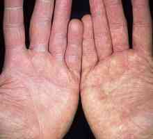 Ciuperca pe degete: simptome și fotografie a bolii