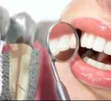 Implantarea dinților sub cheie: prețul implantării unui dinte sub o cheie