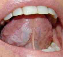 Ulcerele limbii: cauze și cum trebuie tratate