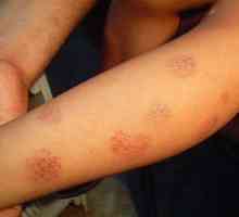 Eczemele sunt asemănătoare cu moneda: semne, simptome și tratament