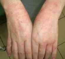 Eczemele pe mâini: cauze și simptome, decât tratamentul