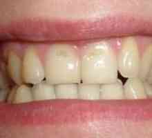 Eroziunea smalțului dinților: cauze, simptome, tratament