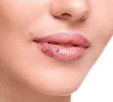 Cum se trateaza cheilita pe buzele adultilor si copiilor