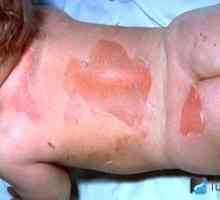 Cum de a trata dermatita scutecului unui copil: moduri și fotografii