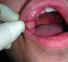 Cum se tratează inflamația mucoasei orale: mijloace și metode de tratament