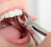 Cum se îndepărtează rădăcina dintelui