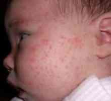 Cum se manifestă alergia alimentară la copil, decât pentru a trata erupția pe față