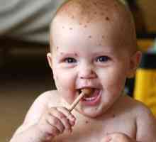 Cum se simte varicela, varicela in tratamentul copiilor si simptomele?