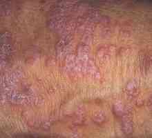 Cum de a vindeca lichen planusul rosu: modalități și fotografii ale bolii
