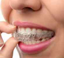 Cum se aliniază dinții fără bretele: metode eficiente