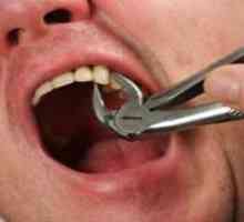 Cum sa rupi un dinte fara durere si teama