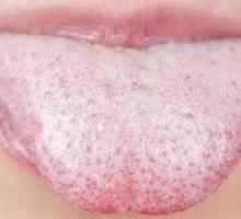 Candidoza cavității orale: tratamentul gurii la adulți