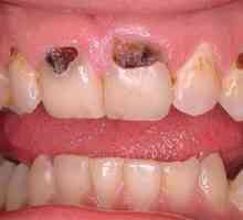 Carii dinților anteriori: cauzele și tratamentul bolii
