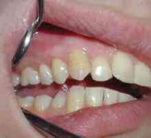 Chistul pe dinte: cauze, simptome și tratamentul bolii