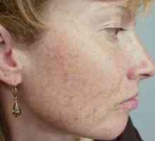 Piele brună și întunecată pe piele: tratament și nume