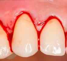 Sângerarea gingiilor: cauze, simptome și tratament