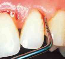 Tratamentul cu gumă în stomatologie și posibile boli