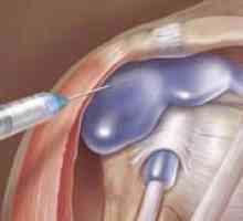Tratamentul excesului de lichid sinovial în articulația genunchiului