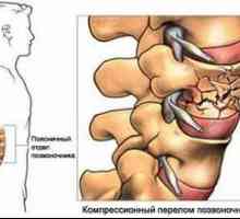 Tratamentul fracturii de compresie a coloanei vertebrale lombare
