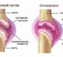 Tratamentul osteoartritei genunchiului de gradul 2