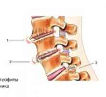 Tratamentul coloanei vertebrale la nivelul coloanei vertebrale și simptomele osteofitelor