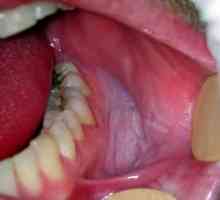 Tratamentul bolilor mucoasei orale