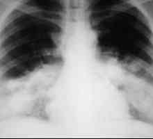 Pneumonia legioneloză. Legioneloza sau boala legionară