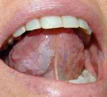 Leucoplazia mucoasei orale: tratament