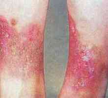 Lipodermatoscleroza sau dermatita varicoasă: simptome